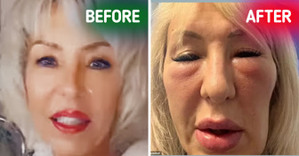 “I Look Like a Gargoyle,” Woman Warns People About Risks While Having Face Fillers