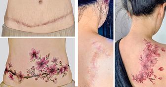 A Vietnamese Artist Uses Her Magical Touch to Help People Regain Self-Confidence by Covering Their Scars With Art