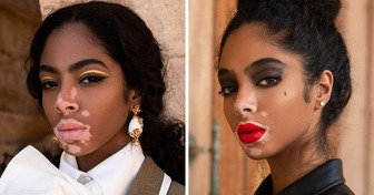 A Rising Star With Vitiligo Proves We Shouldn’t Worship Beauty Standards Anymore