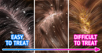 Why Dandruff Appears and How to Effectively Deal With It