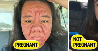 28-Year-Old Woman Reveals the Raw Truth of How Pregnancy Drastically Changes Her Face