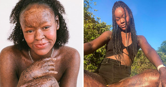 Meet Jeyźa Kaelani, a Model With a Rare Skin Condition Who Proudly Says, “I Am Allowed to Be Beautiful”