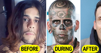 Man Who Was 95% Tattooed Shows Shocking Transformation After Laser Removal Surgery
