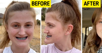 Young Woman Documents Her Double Jaw Surgery, and Leaves Everyone Stunned With the Results