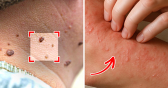 6 Sneaky Diabetes Symptoms You Might Miss