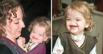 A Baby Born Without a Nose Was Called “Voldemort,” and She Is Not Afraid to Share Her Uniqueness