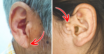 6 Health Signs Your Ears Might Reveal About Your Body