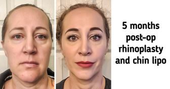 15+ People Who Got Plastic Surgery and Now Look Completely Different