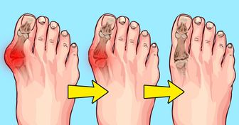 8 Ways to Ease Bunion Pain Naturally