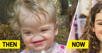 A Girl Born Without Nose, Who Was Called “Voldemort”, Proved Everyone Is Beautiful in Their Own Way