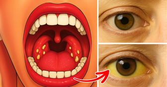 8 Silent Signs of Celiac Disease in Men That May Be Often Overlooked