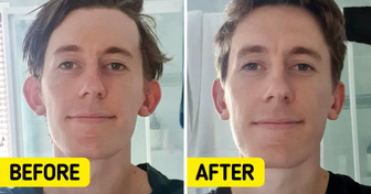 15 People Who Chose Plastic Surgery and Feel Grateful About It