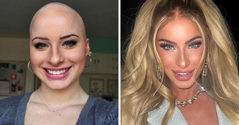 A Girl Who Suffered Greatly From Alopecia Now Makes Profit Out of Her Condition