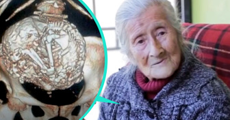 The Story of the Elderly Woman With Malaise That Turned Out to Be a 50-Year-Old Fetus