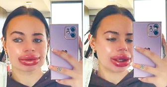This Woman Has a Powerful Advice for People Who Are Thinking of Getting Lip Fillers