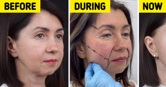 A Woman, 49, Reveals the Dramatic Results of Her Rejuvenation Surgery