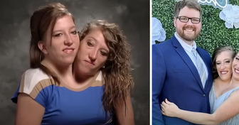 One-Half of The Conjoined Twins Got Married, and It Causes a Stir Online