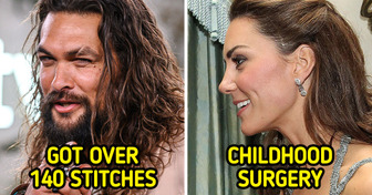 9 Famous People and the Story Behind Their Not-So-famous Scars