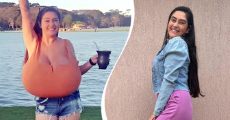 Girl with Gigantomastia Undergoes Surgery, Loses 10kg (22lbs): Positive Story of the Day