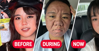 “Are You Allergic to Your Baby?” Woman Shares How Pregnancy Changed Her Face That Proves the Power of Self-Love and Compassion