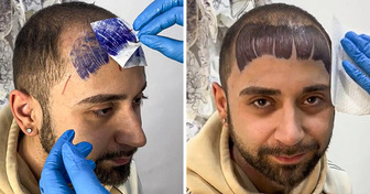 A Balding Man Decided to Tattoo a Fringe on His Forehead, Tattoo Artist Is “Very Happy With the Work”
