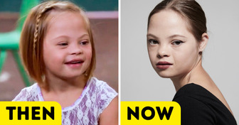 A Baby With Down Syndrome Was Abandoned at Birth, Now at 14, She Became a Hollywood Star