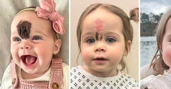 Parents Sent Daughter to Surgery to Remove Rare Birthmark, “People Would Stare at Her”