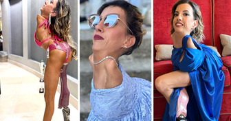 A Woman With Very Rare Condition Shatters Stereotypes and Becomes a Beacon of Hope for Many