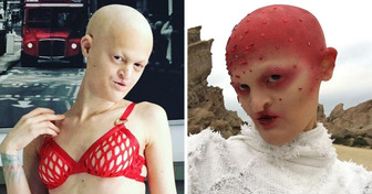 How Model Who Was Called “Alien” Because of Rare Disorder Redefines Beauty Standards