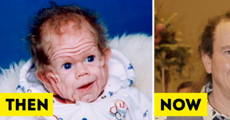The Story of the Baby Who Challenged Doctors With His Rare Disorder for 20 Years
