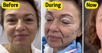 “She Will Need to Change Her Passport,” A Woman, 58, Reveals Facelift Surgery Results Leaving Everyone Speechless