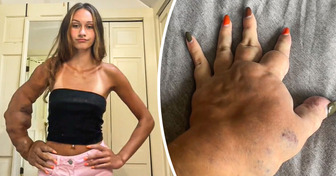 A Girl With a Rare Condition Has the Perfect Response to Online Trolls Telling Her She Should Remove Her Arm
