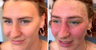 The Viral Trend of Tattooing the Face With ’’Permanent Freckles’’ Divides the Internet