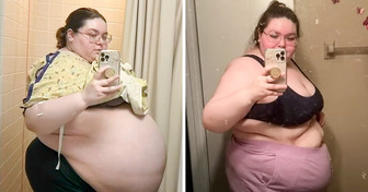 Woman Body-Shamed by Doctors Later Diagnosed With a 104-Pound Ovarian Tumor