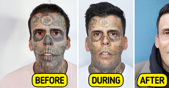 Man Who Was 95% Tattooed Shows Shocking Transformation After Laser Removal Surgery
