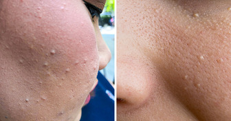 What Those Little White Bumps on Your Skin Are, and What to Do About Them