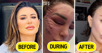 Woman Transforms Her Face Through “Unusual” Facelift, Sparks Debate
