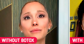 Tearful Ariana Grande Admitted She Had “a TON of Filler and Botox” Over the Years and Explained Why She Stopped