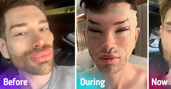 A Man Reveals Dramatic Results of Eye Plastic Surgery and Facial Fillers Removal, Leaving People Stunned