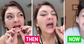 Young Woman Reveals the Dramatic Results of Her Dental Implants Surgery
