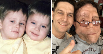 The Journey of Adam Pearson: An Identical Twin With a Rare Disease Who Rose to Stardom
