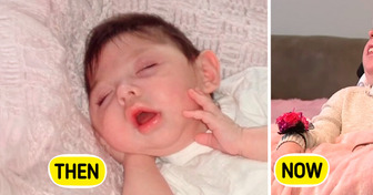 Woman Born Without a Brain Defies the Odds by Celebrating 20th Birthday