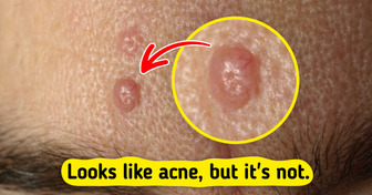 7 Skin Bumps You Might Mistake for Acne