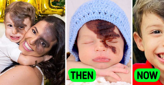 A Mom Recreates Son’s Face Birthmark, «I Wanted to Feel the Prejudice My Son Will Face»