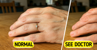 8 Possible Reasons Why Your Veins Are Bulging and When It’s Time to Worry
