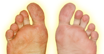 10 Quick Ways to Remove Calluses and Get Baby-Soft Feet