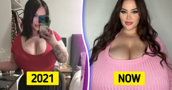 A Woman With Rare Condition Spends Terrifying Sums to Buy a Bra, as Her Breasts Won’t Stop Growing