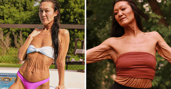 “I Love My Body,” A Woman With a Rare Skin Condition Teaches People to Embrace Their Uniqueness
