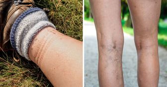 4 Health Issues That Sock Marks May Signal