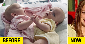 The Story of the Conjoined Twins Who Were Successfully Separated and How They Look Now